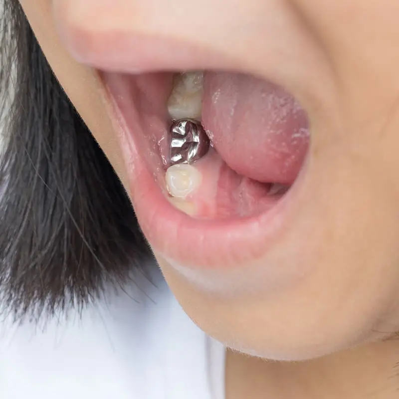Pediatric Dental Crowns