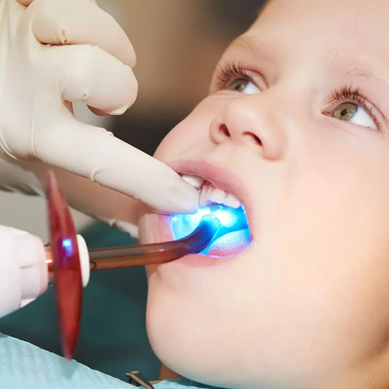 Pediatric Dental Fillings