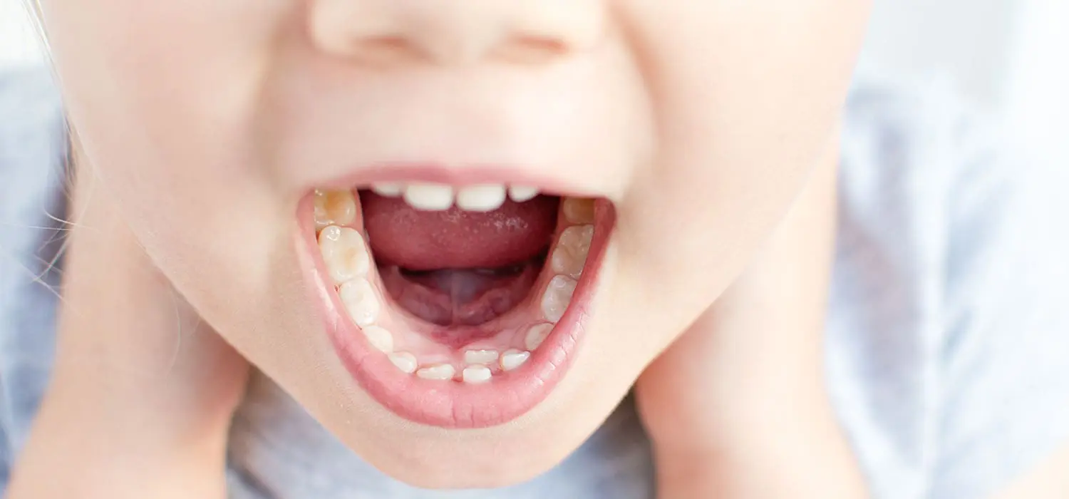 Shark Teeth in Kids: Why an Adult Tooth May Grow Behind a Baby Tooth