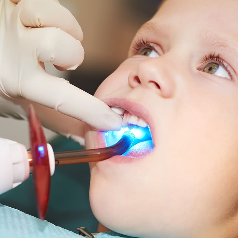 Pediatric Dental Fillings