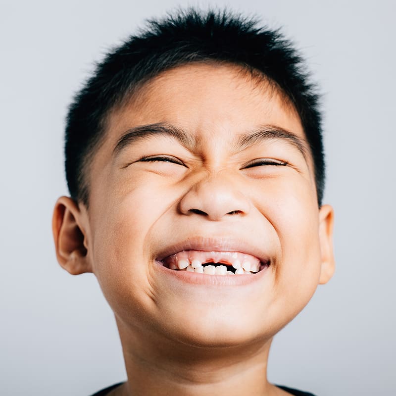 Baby Root Canal (Primary Tooth Nerve Treatment or Pulpotomy)