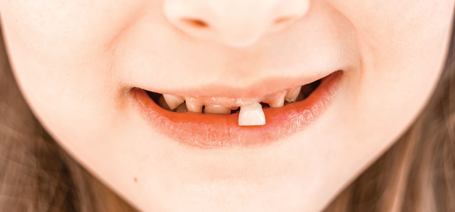 What Happens If a Baby Tooth Falls Out Too Early?